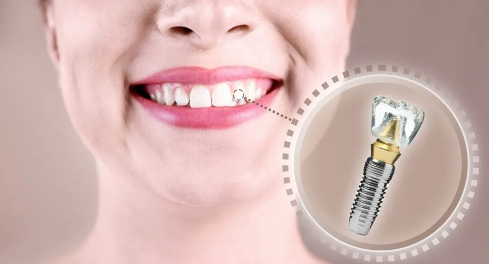 Premier Dental Implants: Restore Your Smile