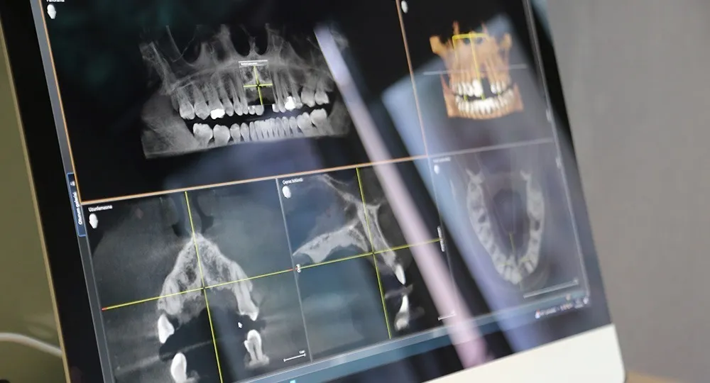 Root Canal Treatment: Save Your Tooth